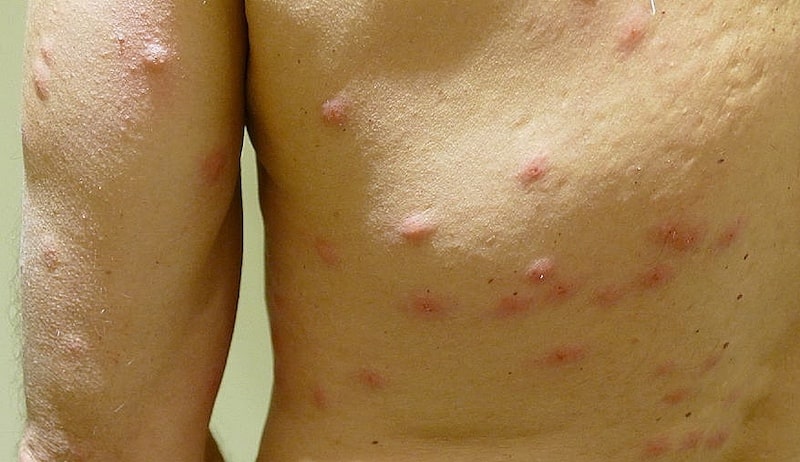 bed-bug-bites-on-human-skin
